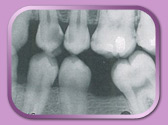 bitewing x-ray